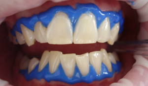 laser-teeth-whitening-716468_1280